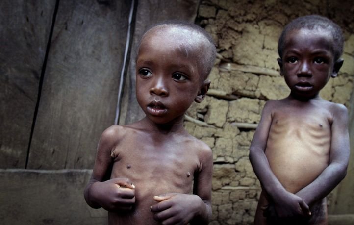 Image result for malnourished child african