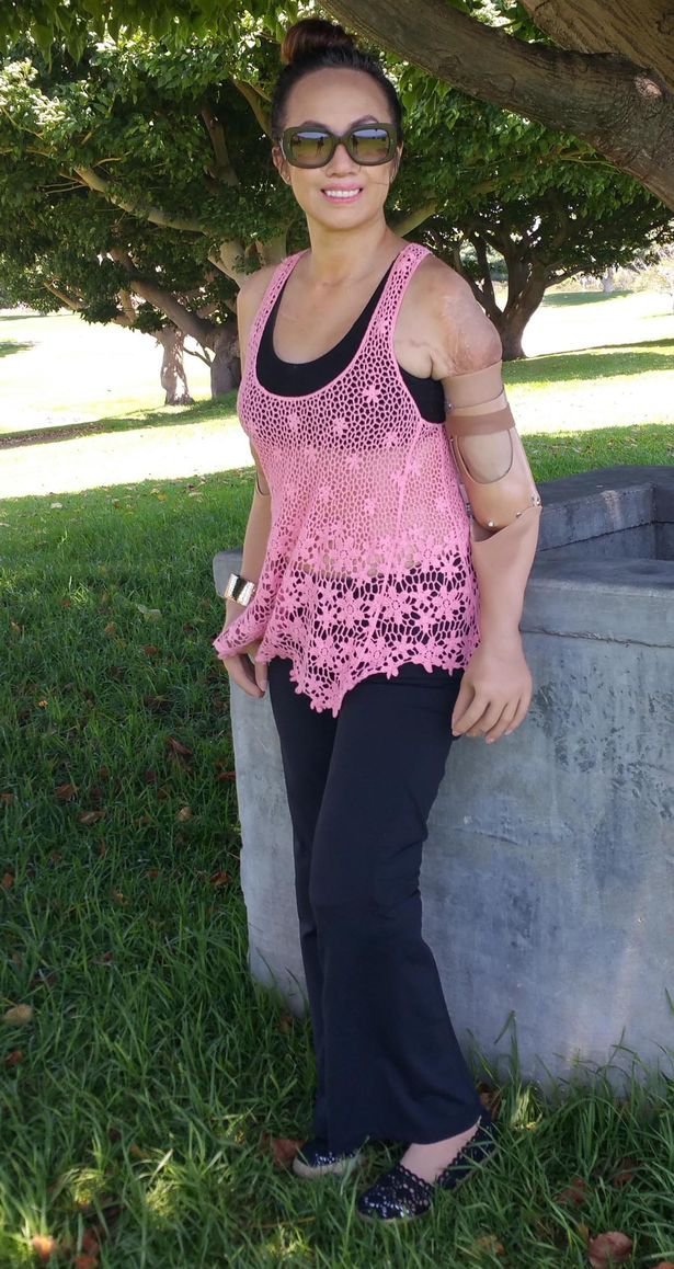 Meet Karen Crespo The Woman Who Lost Her Limbs To Meningitis And Is
