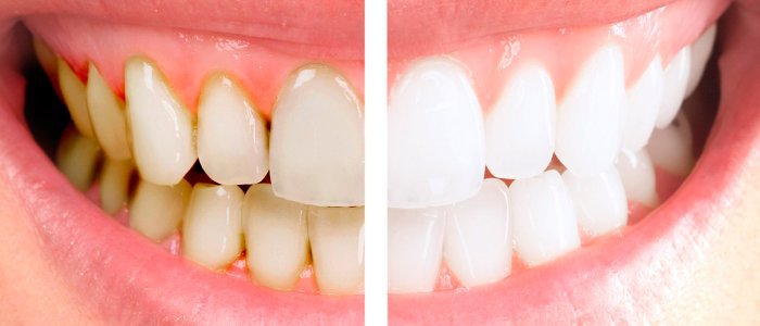 Apparently, Yellow Teeth Are Stronger & Healthier Than White Teeth. Not
