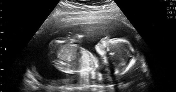 This Ultrasound Video Of An Unborn Baby Clapping Hands Is Going Viral