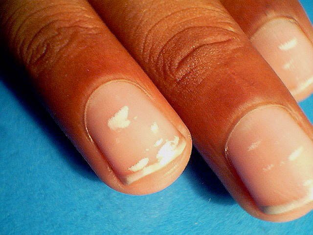 woman-discovers-the-black-mark-under-her-fingernail-is-actually-a