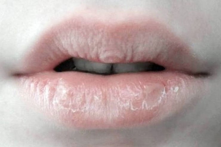 Image result for cracked lips