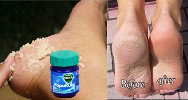 10-natural-remedies-to-get-rid-of-cracked-painful-heels